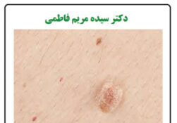 زگیل تناسلی(HPV)